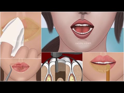 Molar tooth carries removal|| dry and chapped lips treatment at home|| ASMR animation||