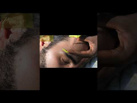 My Wife Picking & Popping My Face Whiteheads ~ So satisfying #Shorts #youtubeshorts