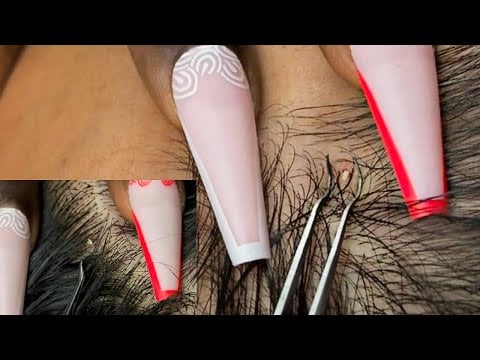 ASMR | Close Concetration NITPICKING The Scalp | soft whispers 💭