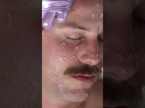 Aggressive ASMR: Dermapen & Micro-Needling Facial Treatment #shorts