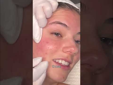 Satisfying Pimple Pop: HUGE Blackhead EXPOSED! #shorts