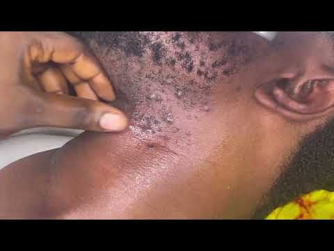 ASMR✨Removing ingrown hairs from my beards and scalp scratching.