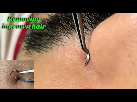 ASMR super ZOOM Removing ingrown hair on face.