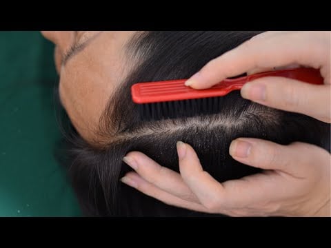 ASMR Scalp Scratching, Scalp Massage Fast And Aggressive For Relieve Stress, Headache