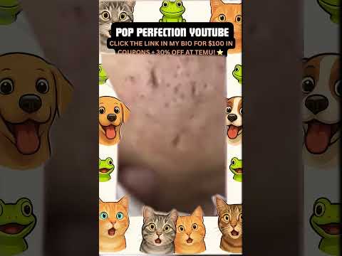 Wow! #pimpleremoval #pimple #pimples #shortsfeed #shortvideo #shorts #short #youtube #youtubeshorts