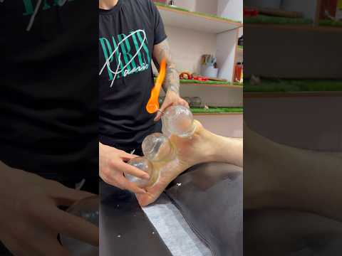 wow😍❤️#shorts #asmr #cupping #cuppingtherapy #viral