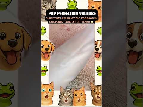 Wow! #pimpleremoval #pimple #pimples #shortsfeed #shortvideo #shorts #short #youtube #youtubeshorts