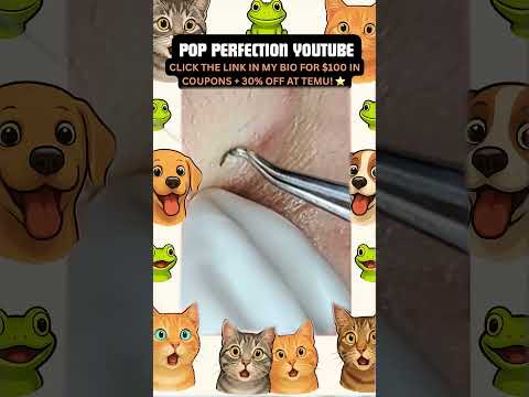 Wow! #pimpleremoval #pimple #pimples #shortsfeed #shortvideo #shorts #short #youtube #youtubeshorts