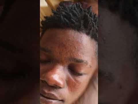Pimples popping #blackheads #satisfying #asmrsounds #relaxing