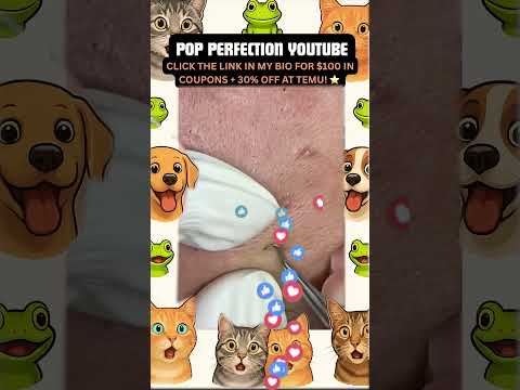 Wow! #pimpleremoval #pimple #pimples #shortsfeed #shortvideo #shorts #short #youtube #youtubeshorts