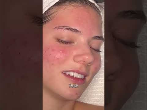 Pimple Popping: Jerry The Pimple's Epic Extraction! #shorts