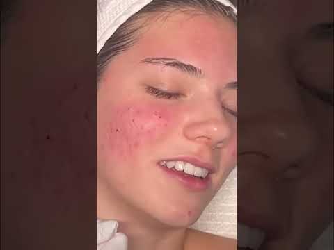 Satisfying Pimple Popping: Naming the Pimple Friends! #shorts