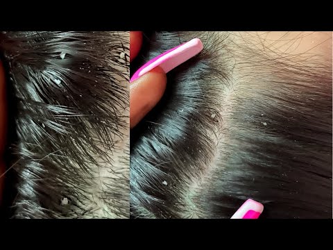 ASMR~ The Most Sleepy NITPICKING Triggers ~ 1HR😴