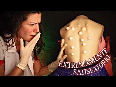 ASMR | ESPREMENDO ESPINHAS GIGANTES (limpeza de pele)
