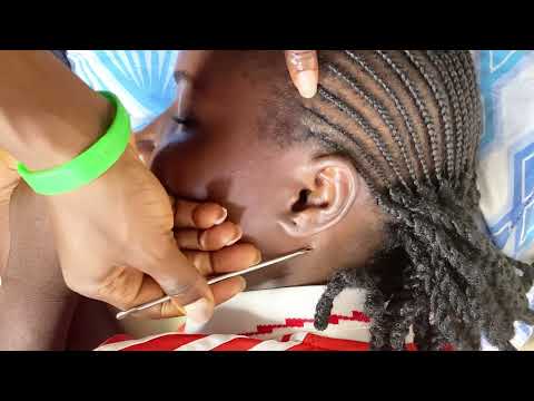 ASMR EAR PICKING WITH SCALP NITPICKING FOR SLEEP