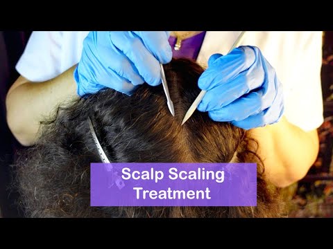 ASMR Dandruff Removal & Scalp Check with Bad Results (Whispered)