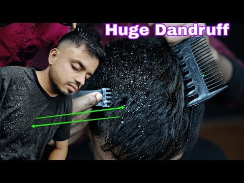 Huge Dandruff Removal From Sculp | ASMR Dandruff Scratching | Satisfying Dandruff Treatment ASMR