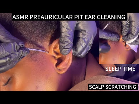ASMR PREAURICULAR PIT CLEANING, EAR CLEANING AND NITPICKING FOR SLEEP VERY RELAXING