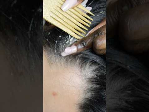 The most UNREAL scalp picking #asmr #nails #shortsfeed #shorts #satisfying #reels #youtube