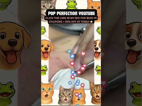 Wow! #pimpleremoval #pimple #pimples #shortsfeed #shortvideo #shorts #short #youtube #youtubeshorts