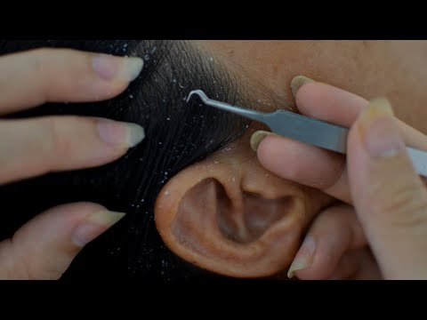 ASMR Relaxing Scalp Check For Sleep ( Dandruff Scratching, Dandruff Removal, Dandruff Treatment )