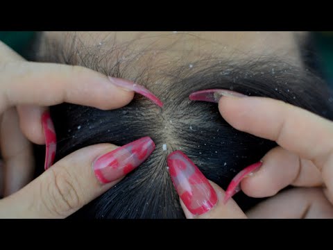 ASMR Scalp Check, Scalp Scratching With Long Nails For Relieve Itchy Make You Fall Asleep