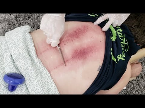 CRAZY TOXIC RELEASE from SCRAPING + EPIC BACK CRACKS from MONDRAGON, DC