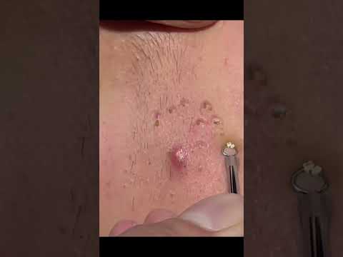 Blackhead Acne Treatment ASMR Barber.           #asmr #asmrbarber #asmrmassage #massage #barbershop