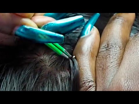 ASMR | Nitpicking Whiteheads With Tweezers, Parting with a wooden African comb