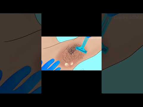 #asmranimation #underarmhairremoval #stopmotionanimation #laserhairremoval