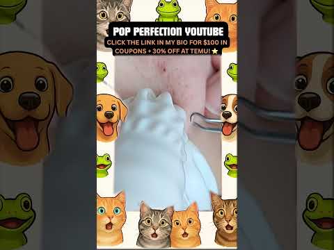 Wow! #pimpleremoval #pimple #pimples #shortsfeed #shortvideo #shorts #short #youtube #youtubeshorts