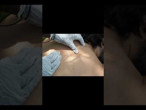 The Most Satisfying Back Nitpicking In the WILD 😜 #shorts #tiktok