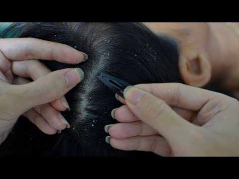 ASMR Scalp Scratching ~ Scalp Check ~ Dandruff Scratching ~ Dandruff Removal ~ Dandruff Treatment
