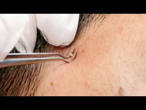 ASMR INGROWN | Whiteheads Face Extractions Treatment |  soft whispers ~ allzoomed
