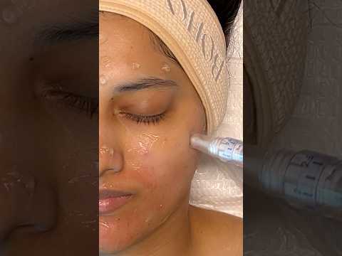 ASMR Facial with Skinpen Microneedling