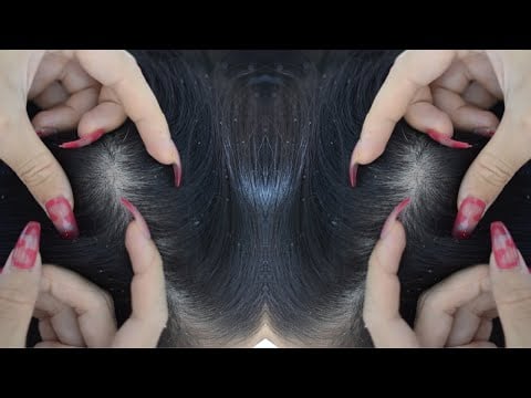 ASMR Scalp Scratching Sounds, Melting Scalp Massage For Deep Sleep ( No Talking )