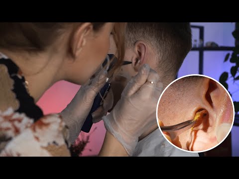 ASMR Hearing Loss Ear Examination | CLOSE-UP Ear Wax Removal and Cleaning on a Real Person