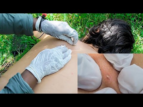 ASMR | Back Nitpicking Whiteheads In The Forest 🌳 | Sounds Of Farm Animals,Crickets, Birds & River