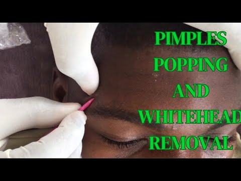 Asmr~  Pimple popping and Whiteheads removal And Blackhead Removal #asmr #satisfying #whitehead