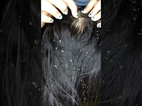 Let’s Remove This Dandruff 😱💆🏻‍♀️ #asmr #satisfying #visualtingle #asmrhairplay #relaxing #shorts