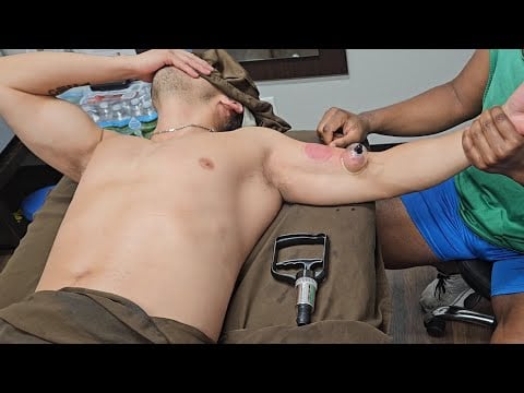 Cupping Rodrigo's Biceps 