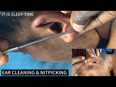 ASMR Ear Cleaning, Scalp Scratching & Back Scratching for Sleep 😴 Intense Tingles