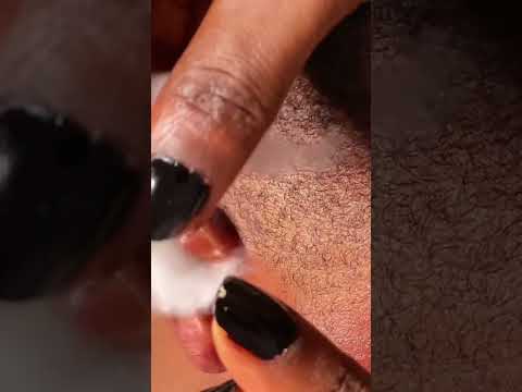 Asmr popping out whiteheads on the ears #asmr #satisfying #relaxing #tingling