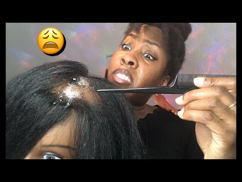 TINGLY AND AGGRESSIVE DANDRUFF REMOVAL & SCALP CHECK💥