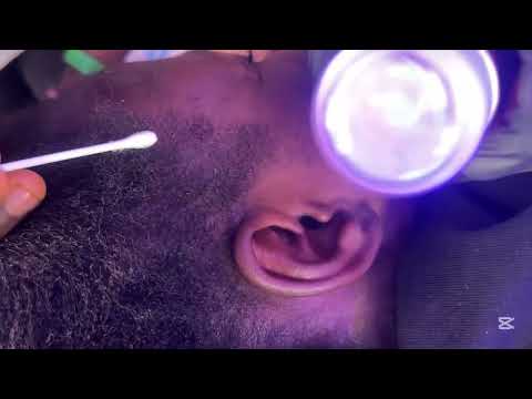 ASMR INTENSE AND AGGRESSIVE EAR MASSAGE, EAR CLEANING AND NITPICKING FOR SLEEP