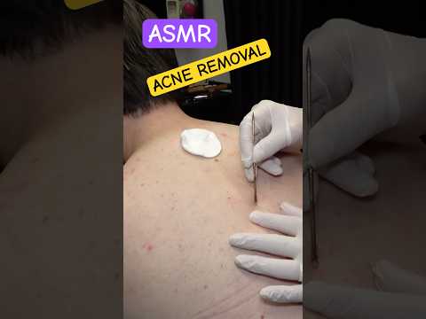 BARBER RAZOR BACK SHAVE AND ACNE REMOVAL #sleepmassage #asmr #razorshave #acneremoval #barber #relax
