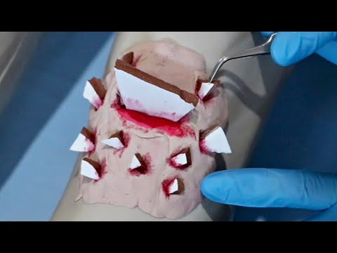 ASMR: REMOÇÃO DE CACO DO JOELHO (cirurgia no joelho) -  para colocar o cérebro para dormir