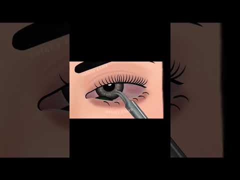 Eye lense removal animation|| ASMR animation||Eye infection treatment|| #asmranimation #animation