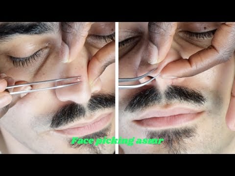 Rare and Super Attentive Face Picking Whiteheads and Tiny Face Hairs 