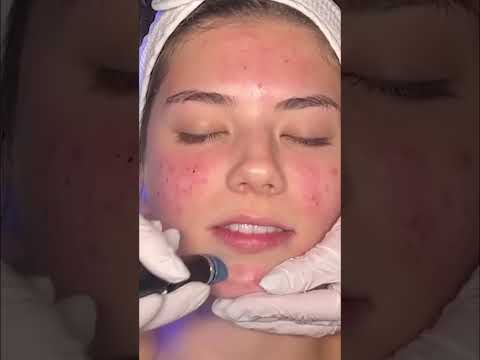 HydraFacial: We Suck Out Everything! #shorts
